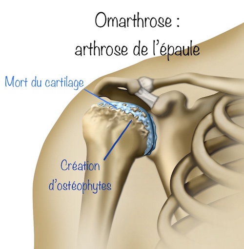 Arthrose de l'épaule et prothèse - Dr El-Sair